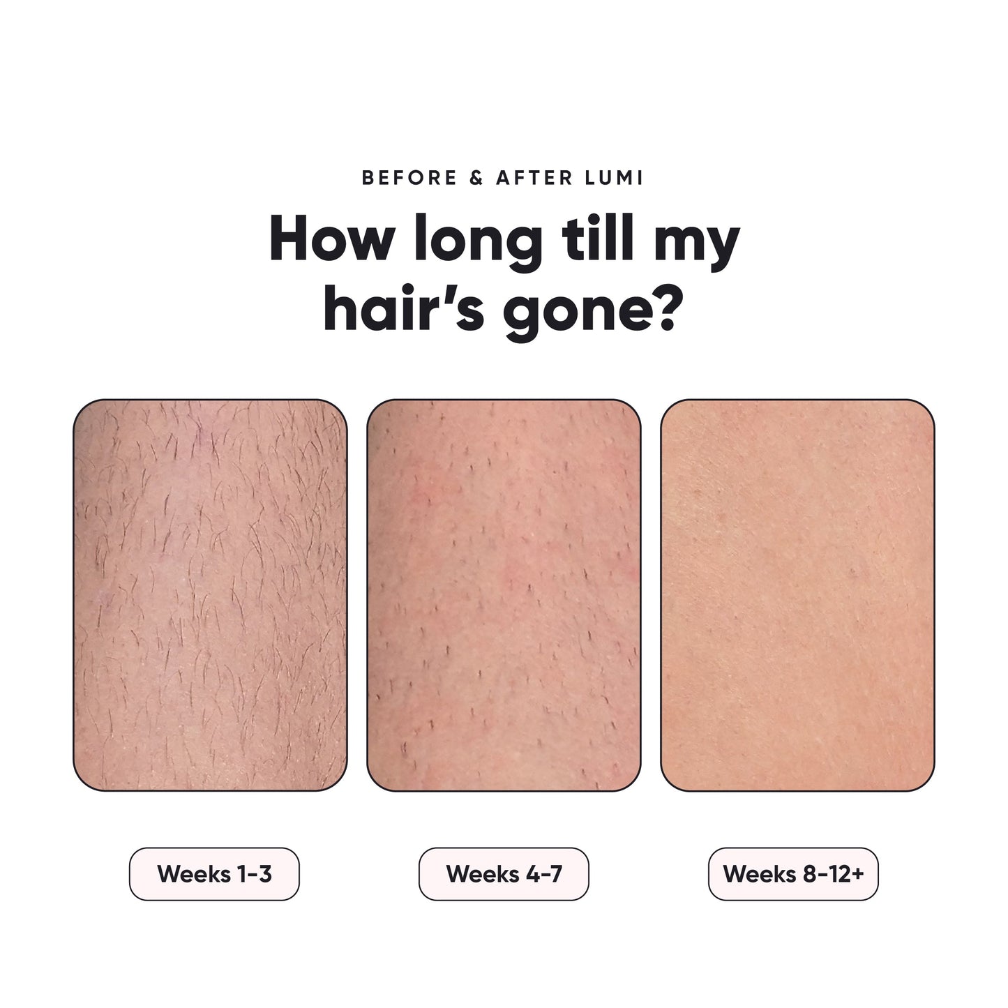 Oracluxe - Permanent Hair Removal Device