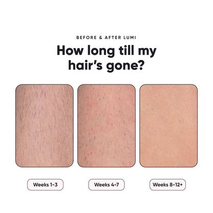 Oracluxe - Permanent Hair Removal Device